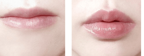 整形美容医院,玻尿酸注射丰唇珠,注射丰唇珠要多少钱
