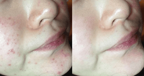 武汉爱思特,祛痘,祛痤疮