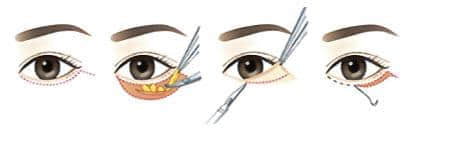 去眼袋的费用,深圳整形美容医院