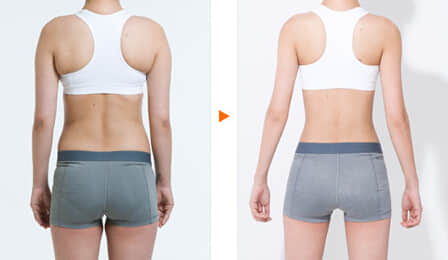 整形美容医院,背部抽脂减肥多少钱