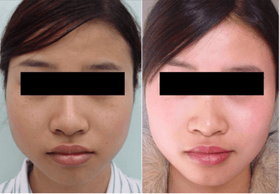 激光美白,激光美白效果