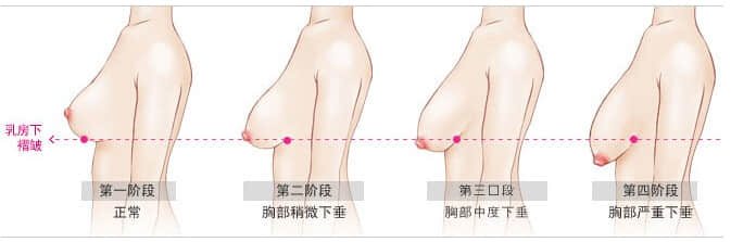 乳房下垂矫正效果,深圳整形美容医院