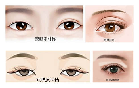 深圳整形美容,深圳眼袋手术,深圳眼袋手术修复