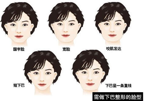 整形美容医院,下颌角整形手术