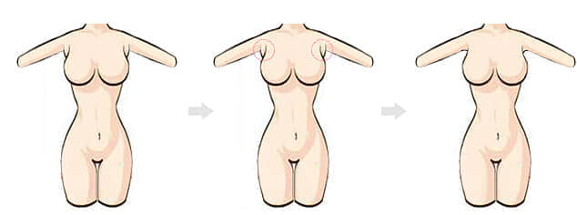 深圳整形美容医院,副乳可以用吸脂术去除吗