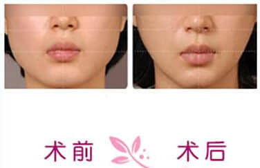 botox瘦脸针,整形美容医院