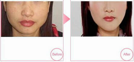 厚唇改薄术,深圳整形美容医院