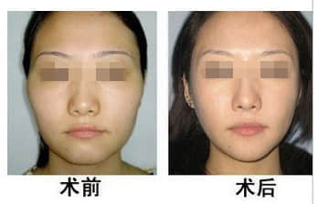 深圳整形美容,自体脂肪填充太阳穴