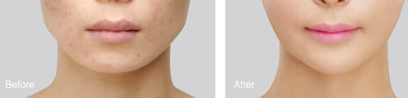 整形美容医院,下颌角整形手术