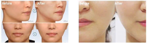 整形美容医院,打肉毒素是多少一针