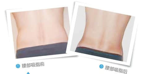 深圳整形,吸脂瘦腰