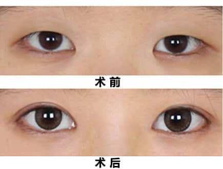 开眼角价格,整形美容医院,深圳整形美容医院