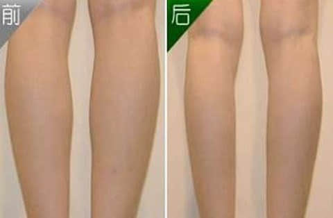 深圳整形美容瘦小腿