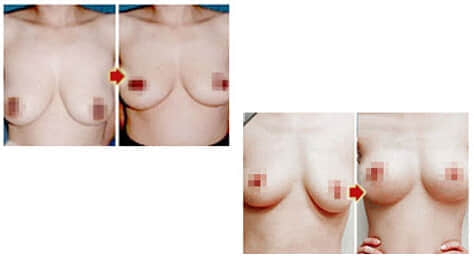 深圳西诺医疗美容,乳房下垂矫正手术