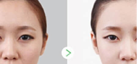 整形美容医院,隔多久时间打水光针一次好