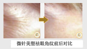 深圳整形美容,整形美容医院,微针美塑一次多少钱