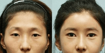 颞部凹陷,深圳整形美容,颞部凹陷怎么填充