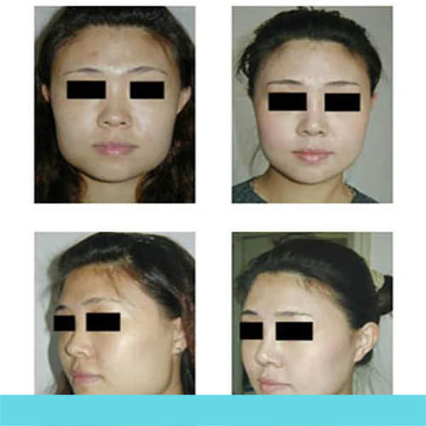 鼻部整形整容手术0035.jpg 鼻部整形整容手术0035.jpg